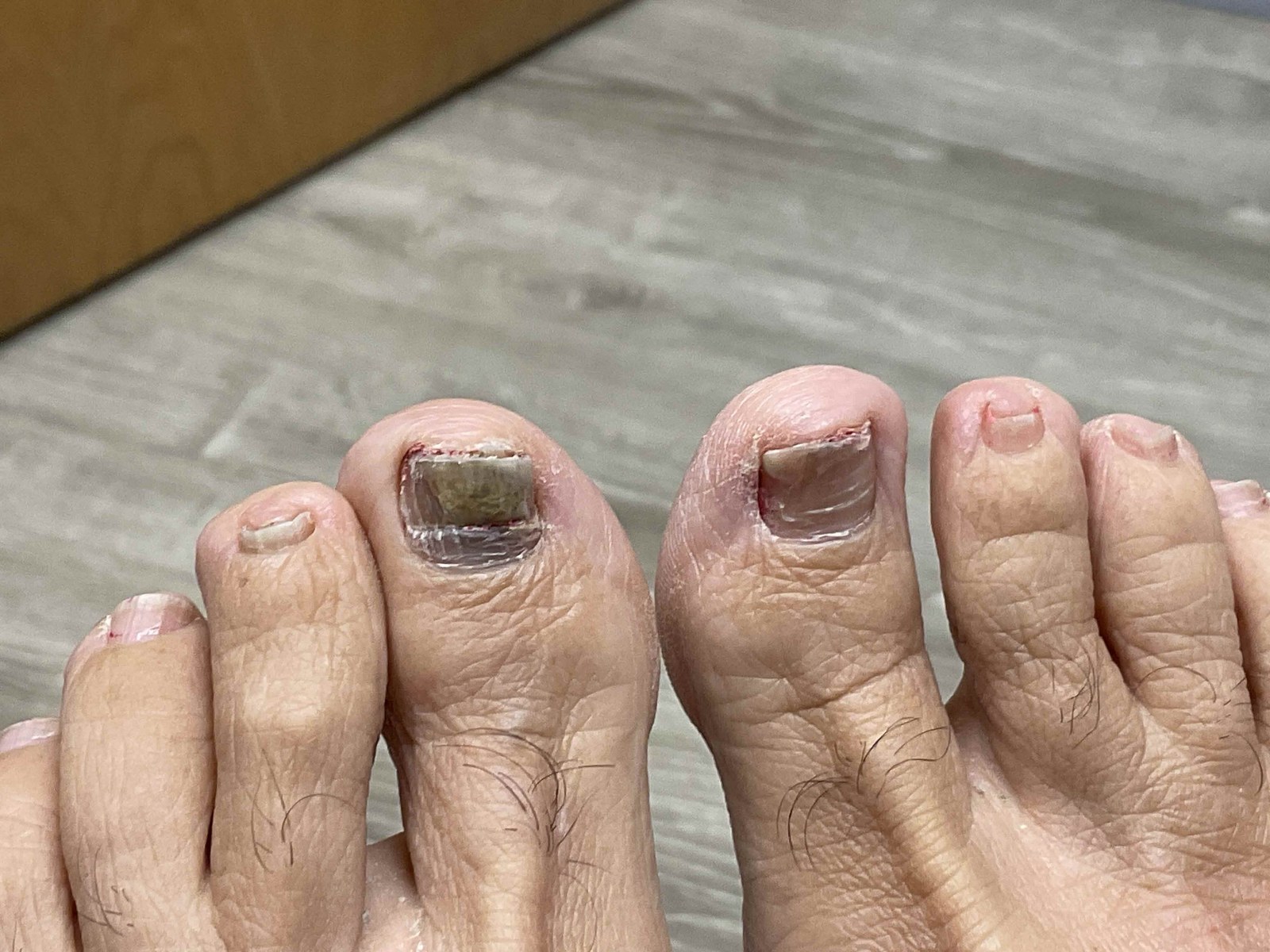 Before treatment: both great toenails thickened and discolored from a fungal nail infection.