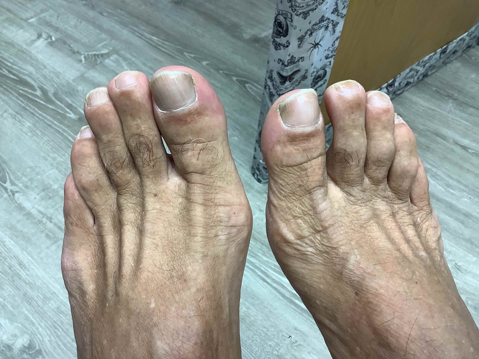 After treatment: both great toenails regrown smooth with normal color and thickness.