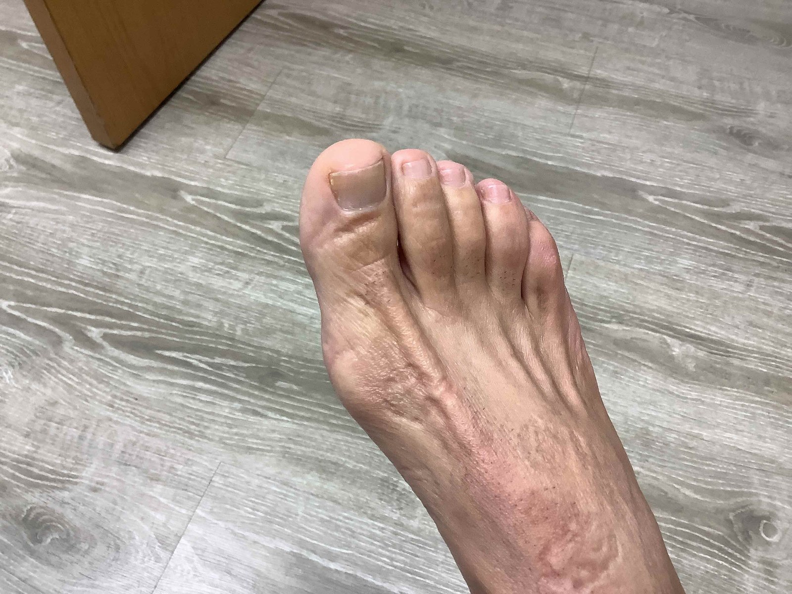 After treatment: the same great toenail fully clear and attached with healthy color.