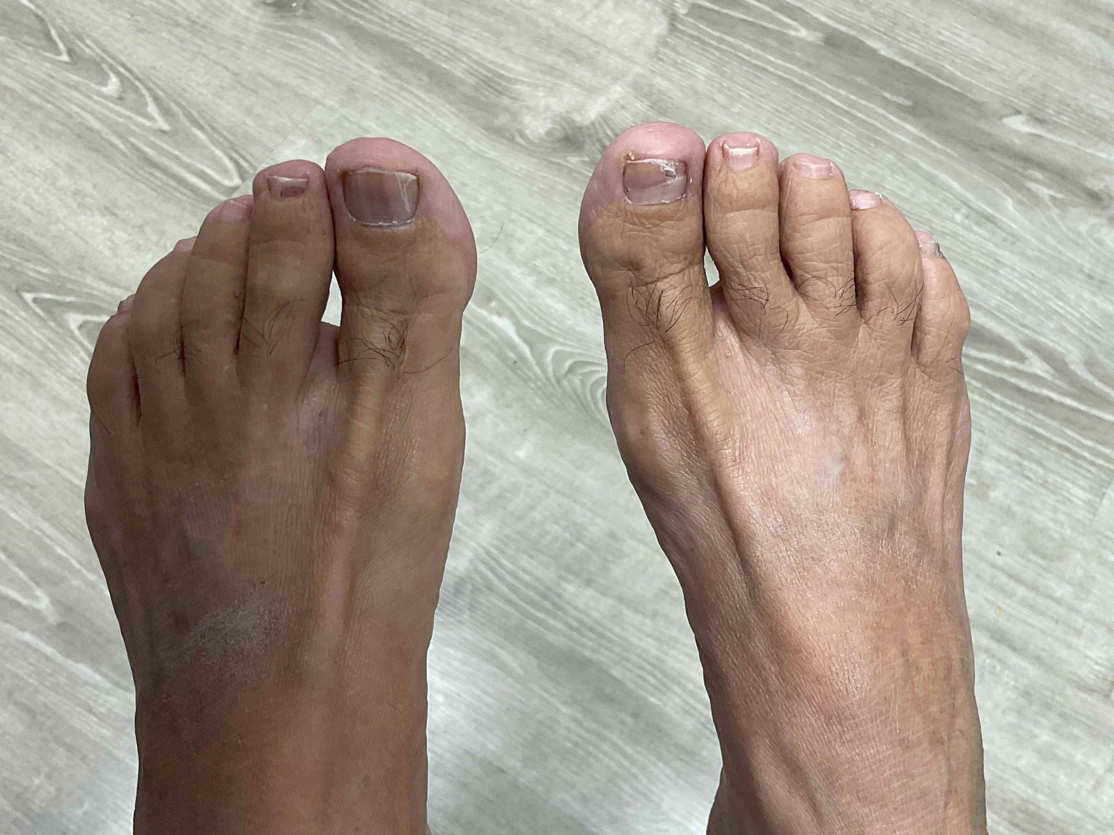 After treatment: the same great toenails grown out clear, smooth, and healthy in color.