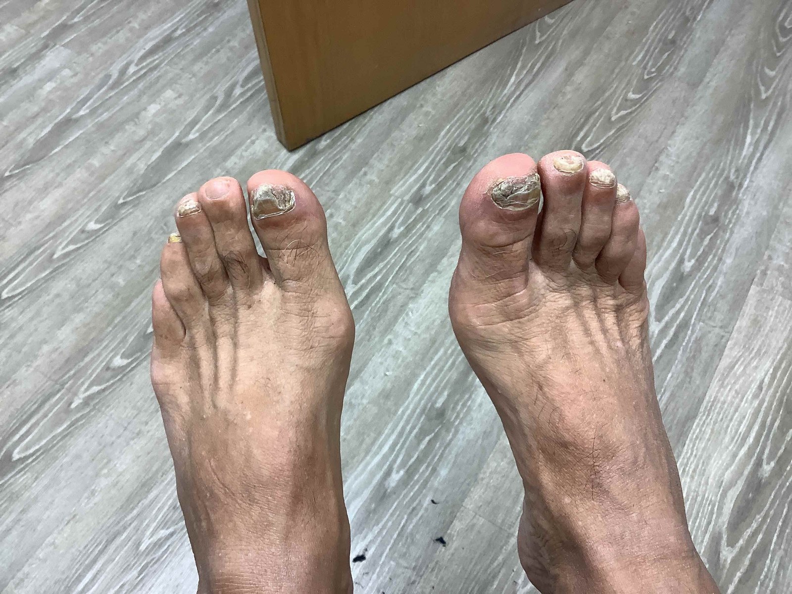 Before treatment: advanced toenail fungus with crumbling, yellow-brown debris under both great toenails.