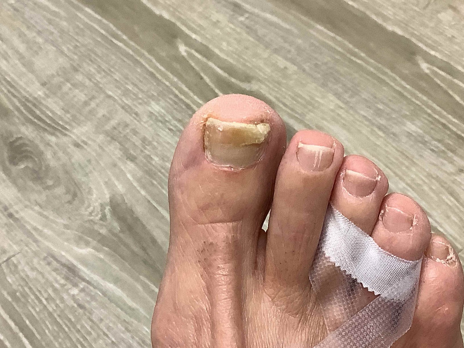 Before treatment: a great toenail with yellow-white streaking and separation from the nail bed.